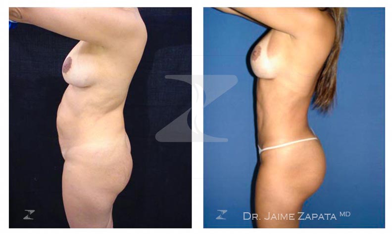abdominoplasty performed by jaime zapata plastic surgeon colombia
