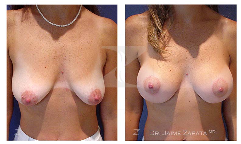 levatamiento de senos con resultados naturales ealizada por el doctor Jaime Zapata cirujano plástico Colombia
