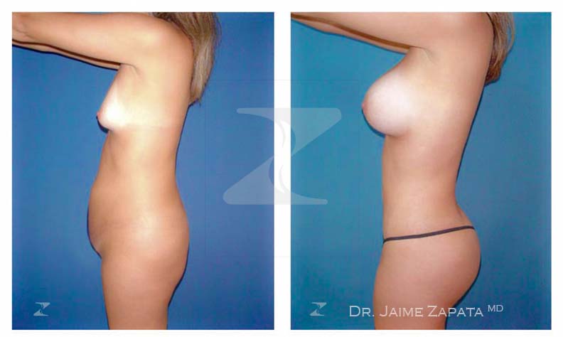 liposculpture and breast augmentation mammoplasty dr jaime zapata plastic surgeon