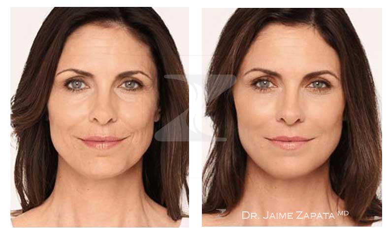radiesse facelift without surgery performed by doctor jaime zapata plastic surgeon colombia